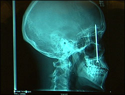 skullx-ray.jpg